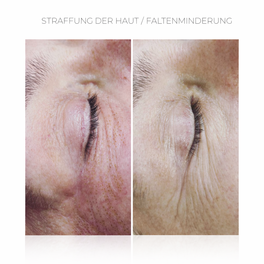PlasCom® Plasma Pen Gerät für Hautstraffung & Verjüngung CFB Cosmetics®